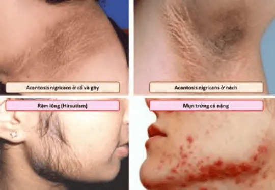 Acanthosis nigricans, rậm lông và mụn trứng cá nặng