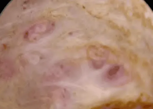 Adenomyosis qua nội soi buồng tử cung