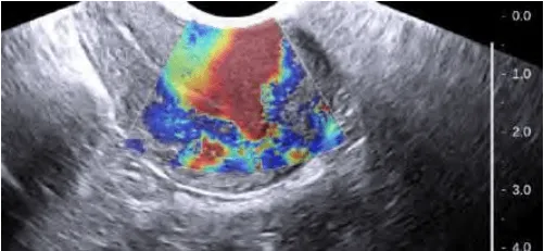 Adenomyosis trên siêu âm đàn hồi