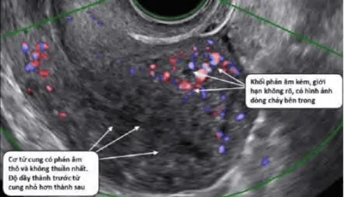 Adenomyosis trên siêu âm Doppler