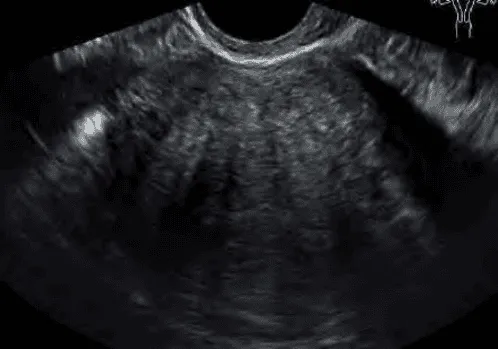 Adenomyosis trên siêu âm