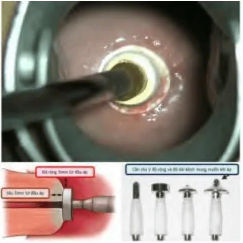 Áp lạnh cổ tử cung