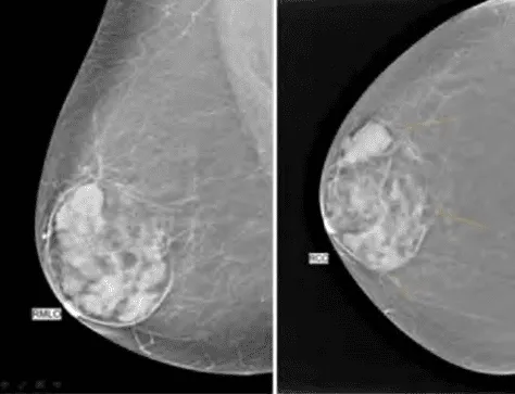 Nhũ ảnh của Hamartoma vú, phim LMO vú phải và phim CC