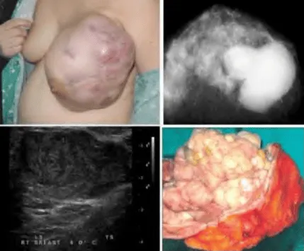 Bướu diệp thể