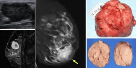 Bướu sợi tuyến