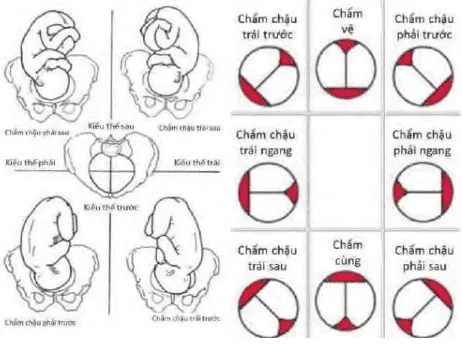 Các kiểu thế trong ngôi chỏm