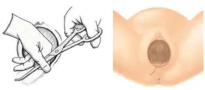 Cắt tầng sinh môn