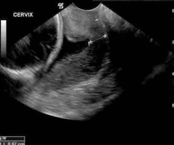 Chiều dài cổ tử cung