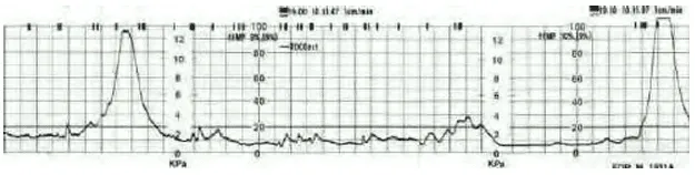 Cơn co Braxton-Hicks