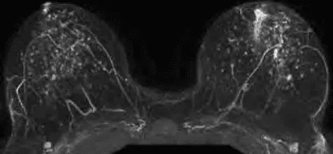 Cộng hưởng từ tuyến vú