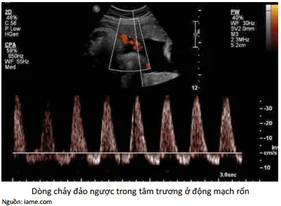 Đảo ngược dòng chảy trong tâm trương động mạch rốn