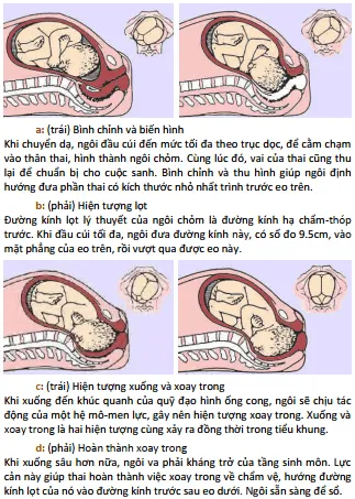 Đẻ thường ngôi chỏm a-d