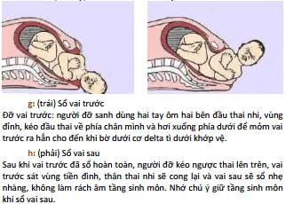 Đẻ thường ngôi chỏm g-h