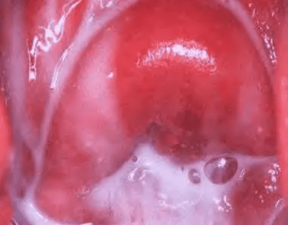 Dịch âm đạo bất thường