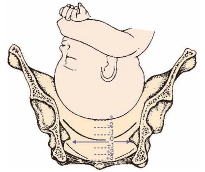 Độ lọt ngôi thai