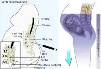 Vị trí đâm kim tê ngoài màng cứng
