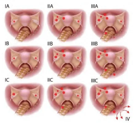 Các giai đoạn ung thư buồng trứng theo FIGO