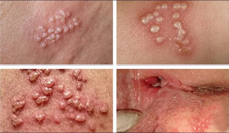 Herpes sinh dục