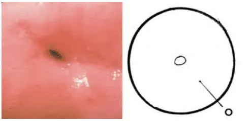 Hình ảnh cổ tử cung bình thường qua soi cổ