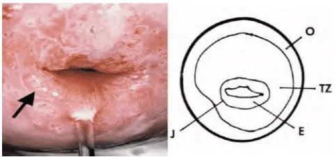 Hình ảnh cổ tử cung chuyển sản với cửa tuyến, đảo tuyến