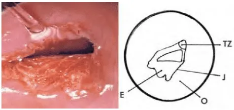 Hình ảnh chuyển sản với ranh giới lát trụ, biểu mô lát non