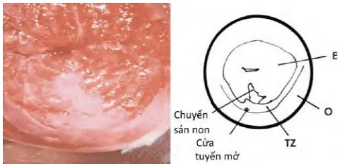 Hình ảnh cổ tử cung tái tạo với lưỡi biểu mô chuyển sản lát non