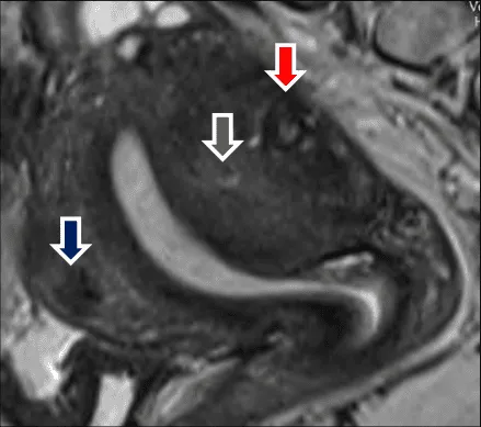 Cộng hưởng từ của adenomyosis
