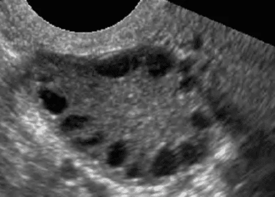 Hình ảnh siêu âm của hội chứng buồng trứng đa nang