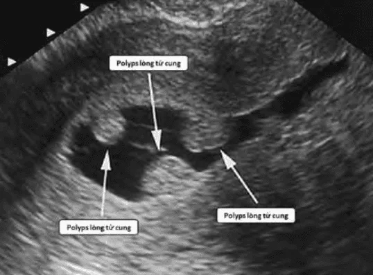 Hình ảnh siêu âm bơm nước của polyps buồng tử cung (SIS)