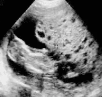 Hình ảnh siêu âm thai trứng bán phần