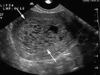 Siêu âm thai trứng toàn phần