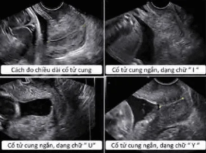 Hình dạng lỗ tử cung