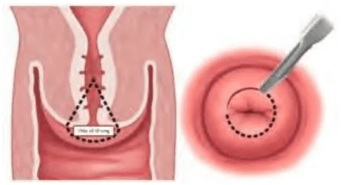 Khoét chóp cổ tử cung bằng dao lạnh