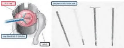 LEEP và các loại vòng cắt phổ biến