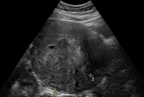 Leiomyosarcoma trên siêu âm