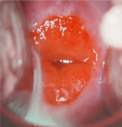 Lộ tuyến cổ tử cung