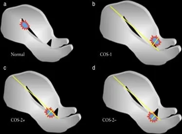 Mối liên hệ thai và sẹo mổ lấy thai