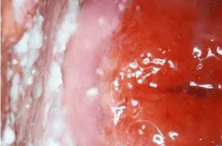 Viêm âm đạo do Candida