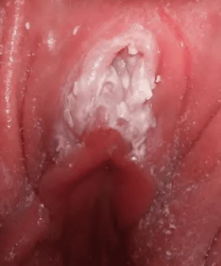 Viêm âm hộ do Candida