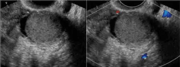 Nang lạc tuyến nội mạc tử cung ở buồng trứng