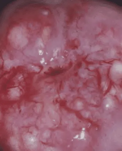 Nang Naboth trên soi cổ tử cung