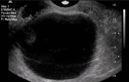 Nang noãn nang trên siêu âm