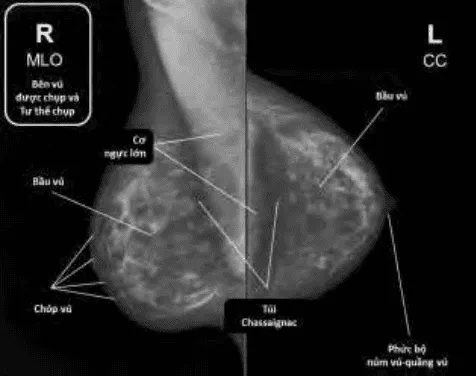 Nhũ ảnh, phim MLO (trái) và phim CC (phải).