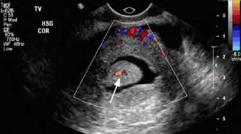 Phân biệt polyp và u xơ tử cung FIGO 1 bằng Doppler