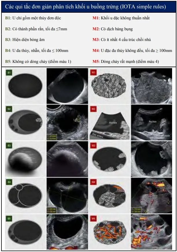 Phân loại u buồng trứng theo IOTA