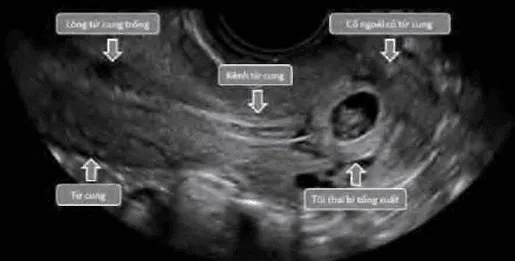 Sảy thai khó tránh