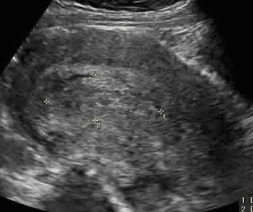 Sảy thai không trọn