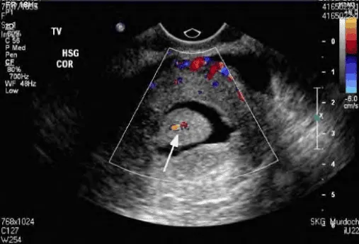 Siêu âm bơm nước buồng tử cung