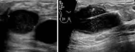 Siêu âm tuyến vú