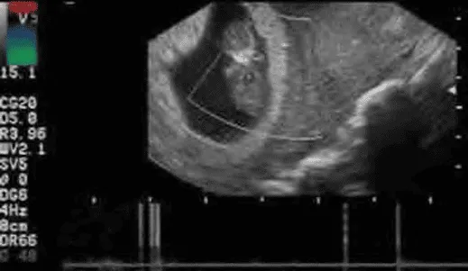 Thai ngưng phát triển